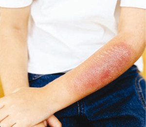 Queimadura_queimado_crianca_tratamento_tratar_revista_gente_nova_01